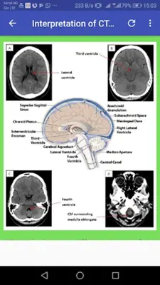 CT Brain Basic Interpretation android App screenshot 4